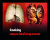 smoking-causes-fatal-lung-cancer.jpg