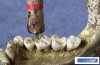 Ancient-methods-of-dental-treatment-001.jpg